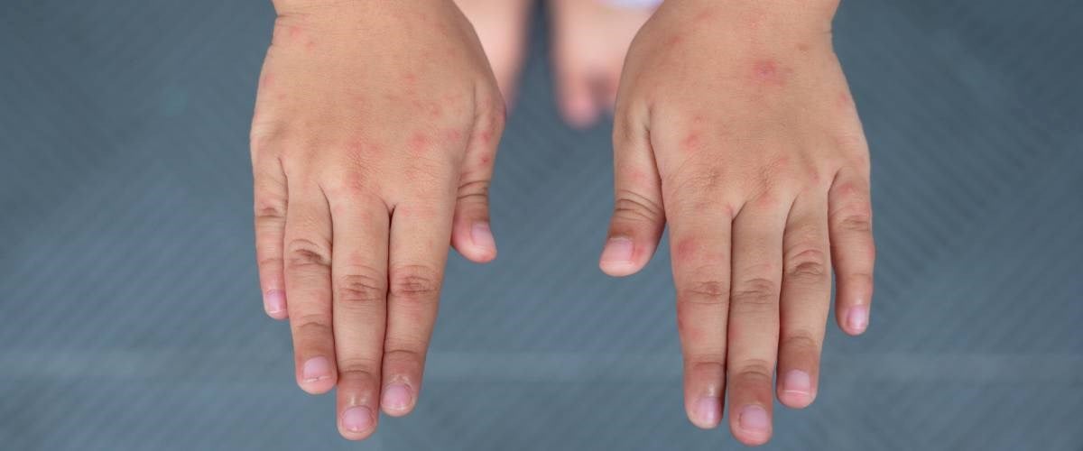 utslett på hender - barnesykdommer 1200x500.jpg