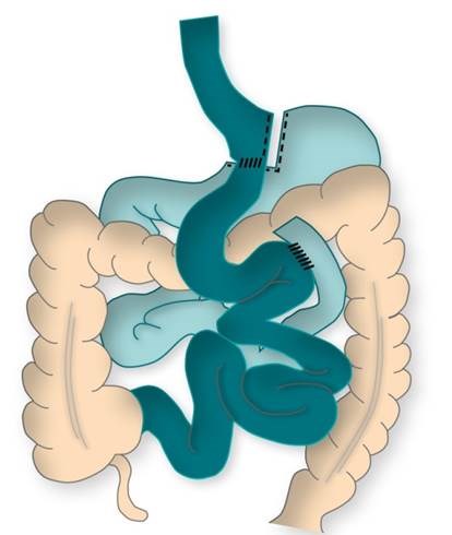 Ilustrasjon av gastric bypass (slankeoperasjon)