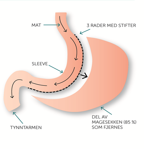 Illustrasjon av en gastric sleev - slankeoperasjon