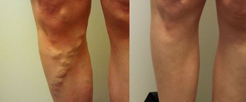 bilder av ben med åreknuter før og etter behandling. foto.